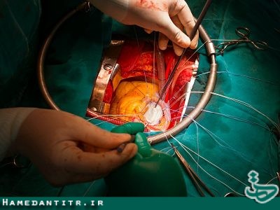 ۴۶۹ عمل جراحی قلب باز در بیمارستان قلب فرشچیان